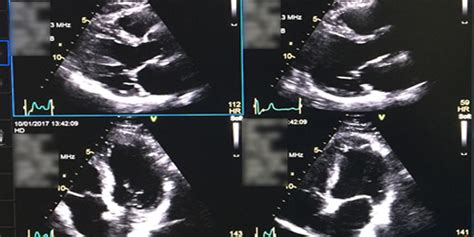 stress echocardiogram results